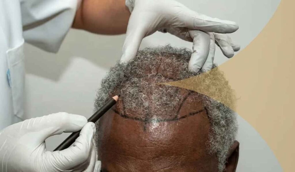 Turkey Hair Transplant