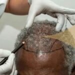 Turkey Hair Transplant