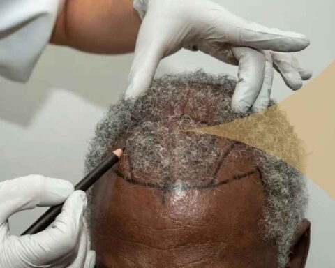Turkey Hair Transplant